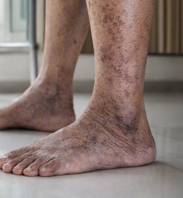 An elderly man sitting on a sofa, rubbing his lower leg in discomfort, while a healthcare professional sitting next to him listens attentively with a tablet in hand. The scene illustrates a consultation for Peripheral Artery Disease (PAD) symptoms in an older adult.
