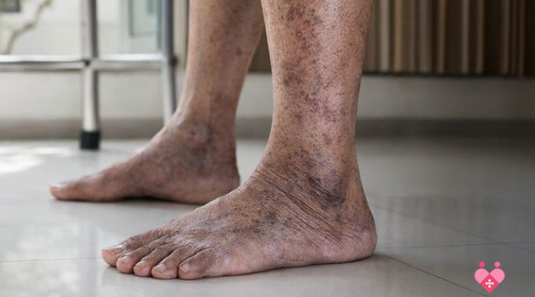 An elderly man sitting on a sofa, rubbing his lower leg in discomfort, while a healthcare professional sitting next to him listens attentively with a tablet in hand. The scene illustrates a consultation for Peripheral Artery Disease (PAD) symptoms in an older adult.